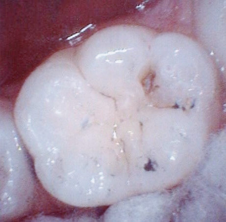 Upclose photo of a tooth showing decay