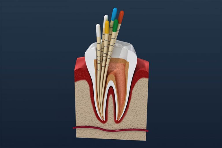 Illustration of tooth cross section with root canal therapy being performed