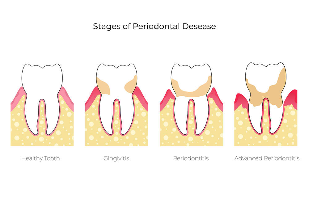 Stages of Periodontal Disease Blog Leominster Family Dentists