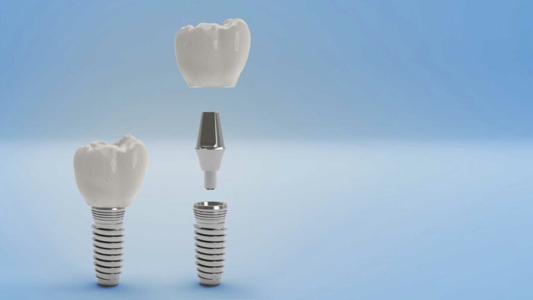 illustration of a dental implant