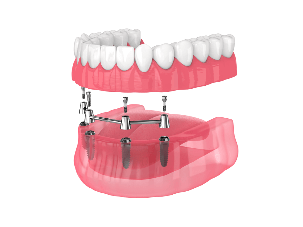 illustration of an entire arch of teeth being applied to with 4 implants