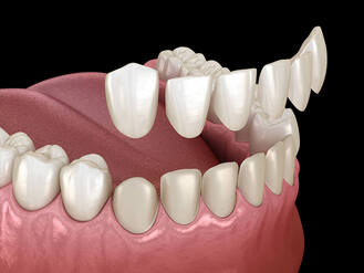 Dental Veneers in Leominster, MA at Leominster Family Dentists